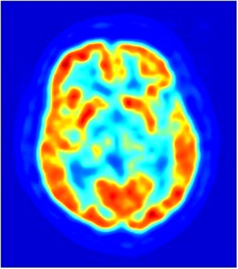 Vue axiale du cerveau par tomographie par émission de positons